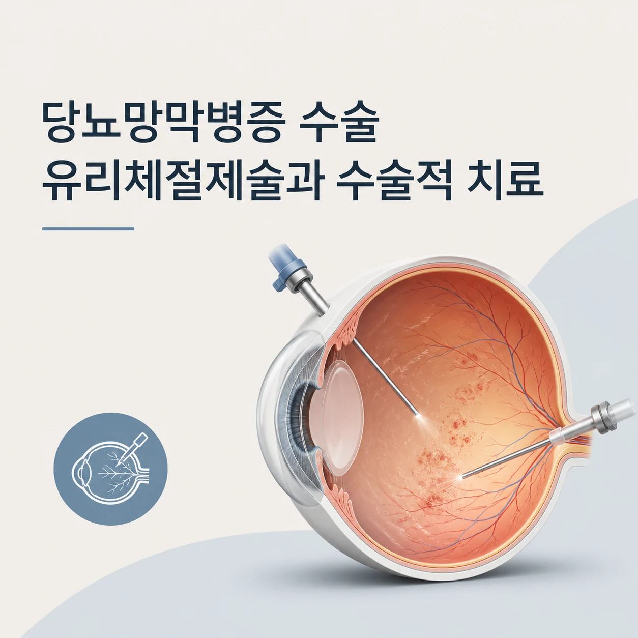당뇨망막병증 수술 유리체절제술과 수술적 치료 1 당뇨망막병증 수술 대표 이미지