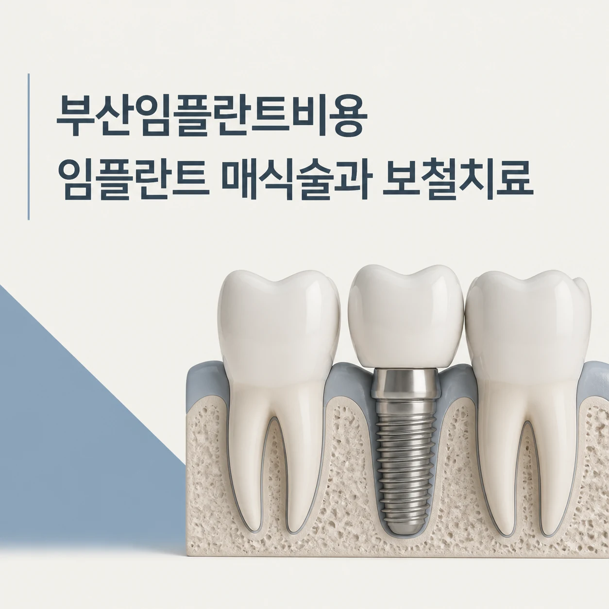 부산임플란트비용 대표 이미지